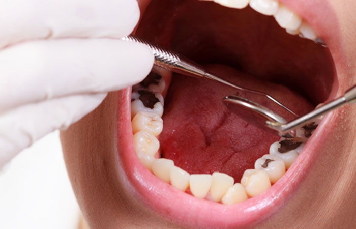 caries